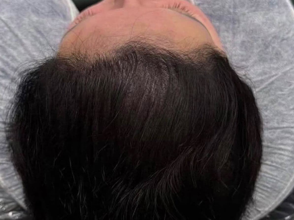 After SCALP MICROPIGMENTATION