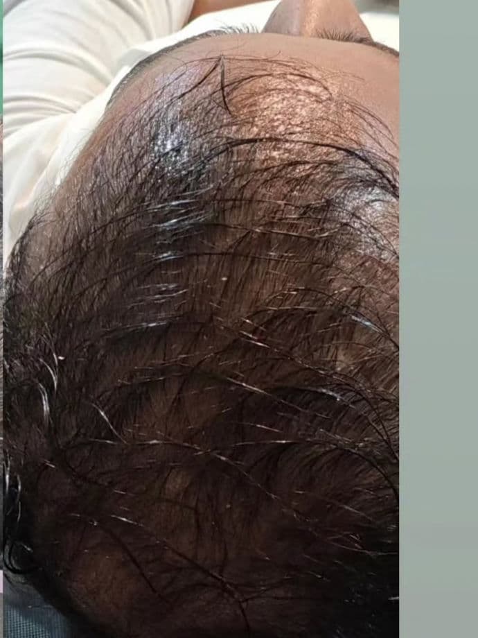 After GFC Hair Restoration