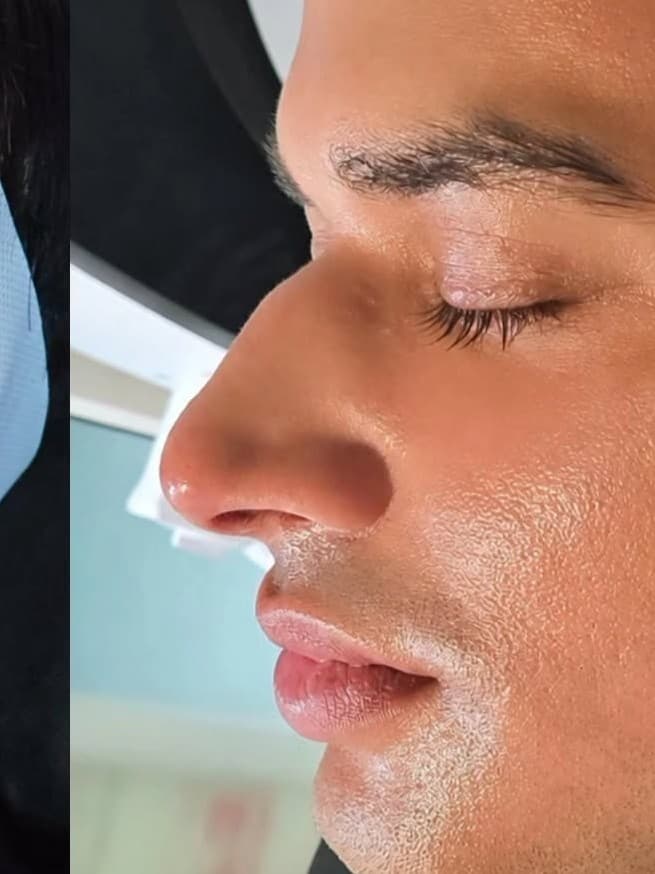 After ADVANCED HYDRA + CARBON LASER