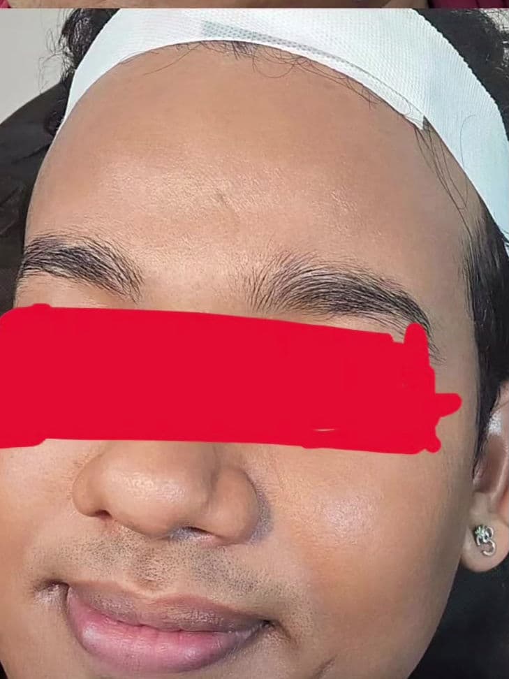 After 5-SESSION COMBINATION THERAPY MICRONEEDLING + MESOTHERAPY