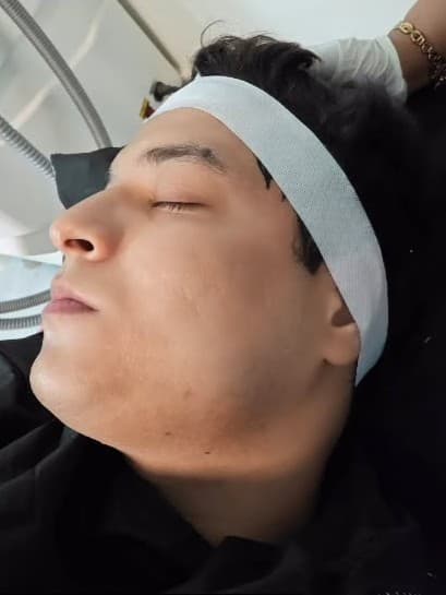 After Subcision + PRP for Acne Scars