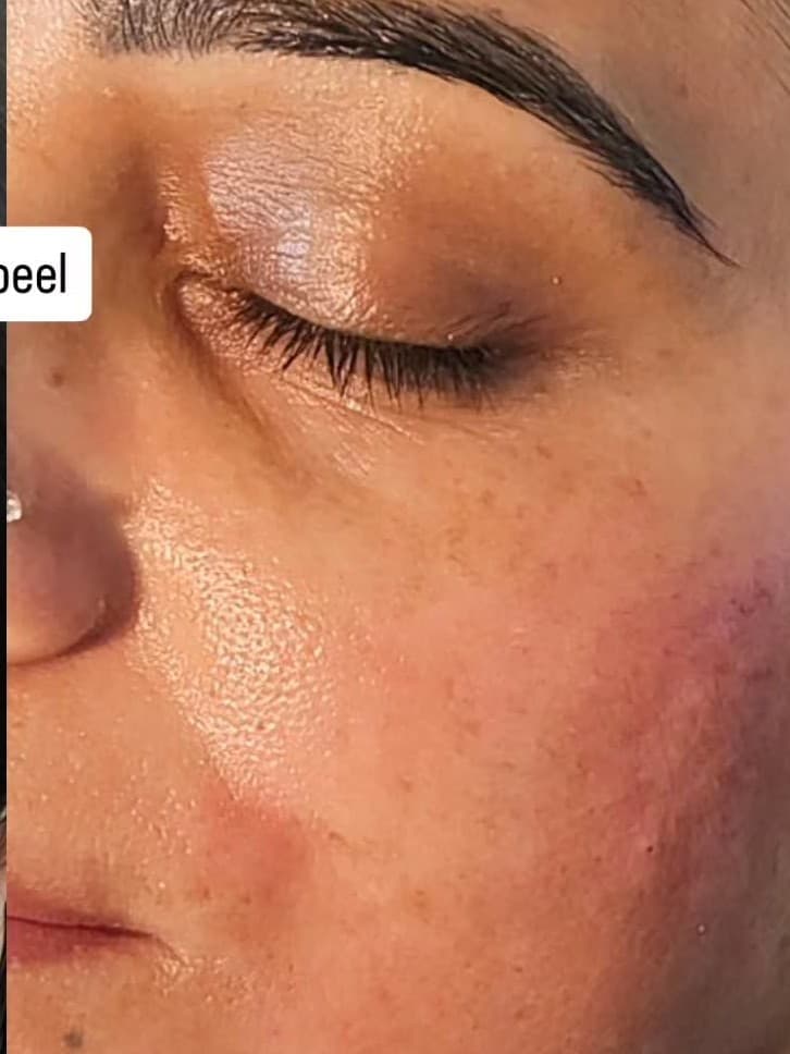 After Anti-Pigmentation Treatment with Mi-Line Advanced Peel