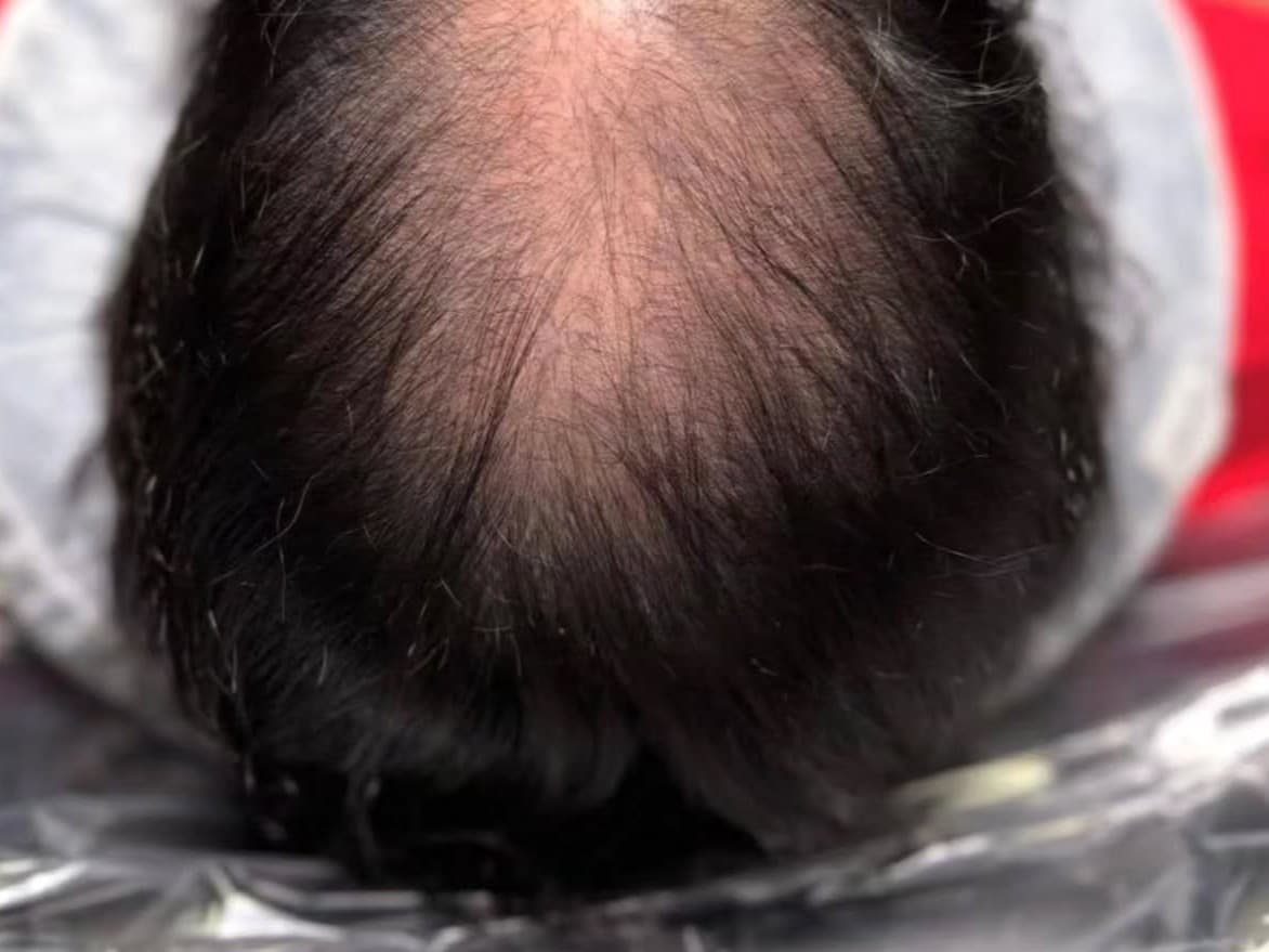 Before SCALP MICROPIGMENTATION