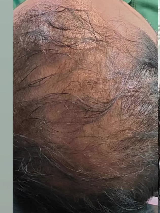 Before GFC Hair Restoration
