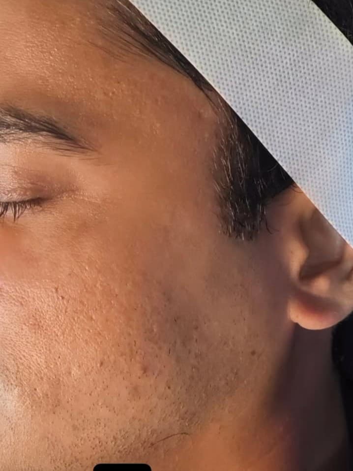 Before ADVANCED HYDRA + CARBON LASER