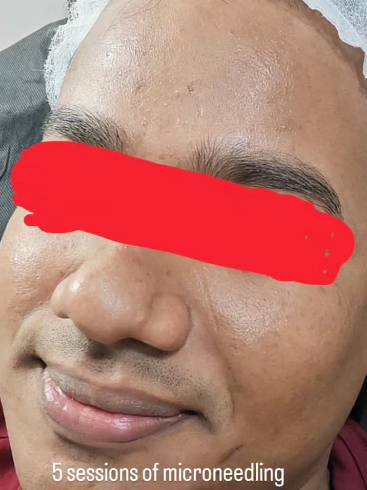 Before 5-SESSION COMBINATION THERAPY MICRONEEDLING + MESOTHERAPY