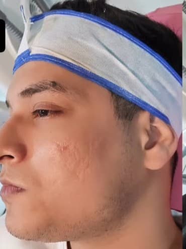 Before Subcision + PRP for Acne Scars