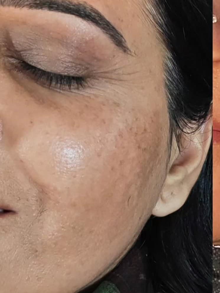 Before Anti-Pigmentation Treatment with Mi-Line Advanced Peel